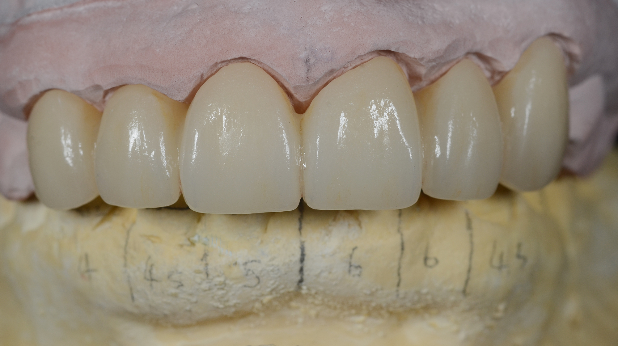 Katana Zirconia Bridge with Layering